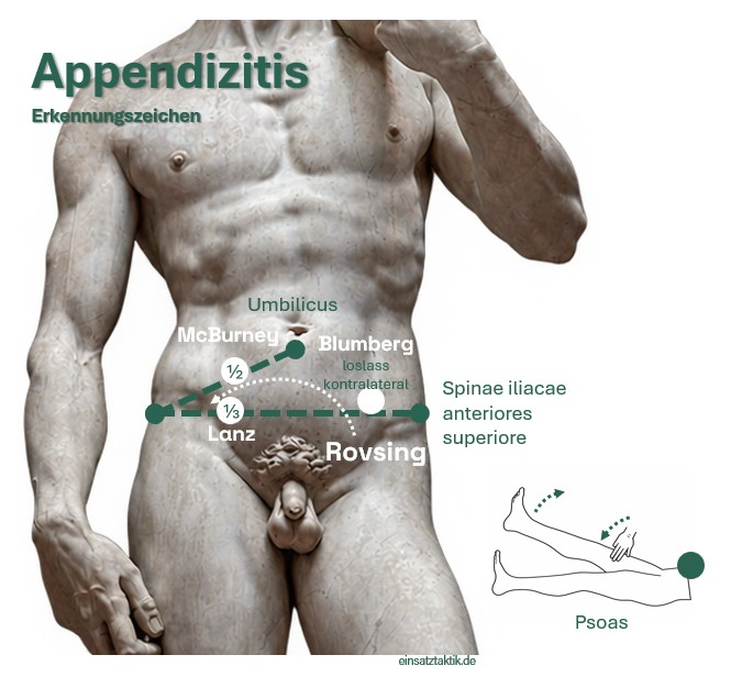 Appendizitis