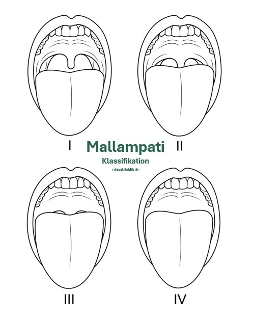Mallampati
